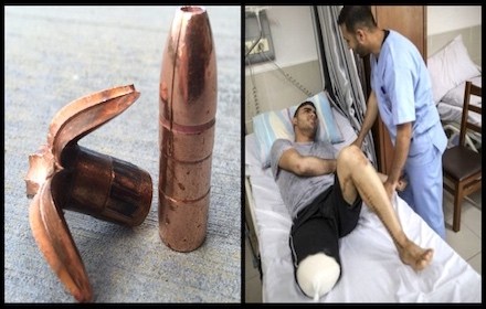 Israeli use of butterfly bullets on Gaza civilians